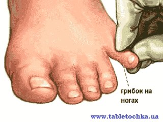 Лечение микозов