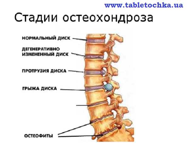 остеохондрози2