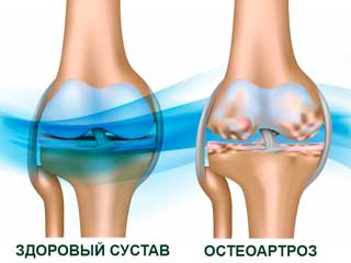 остеоартрозсустав
